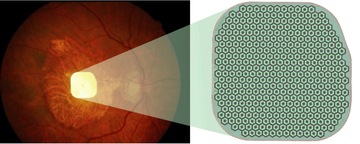 Science Corp.’s PRIMA Retinal Implant Restores Functional Central Vision to Patients with Geographic Atrophy Caused By Age-Related Macular Degeneration, a Leading Cause of Blindness, The New England Journal of Medicine Reports